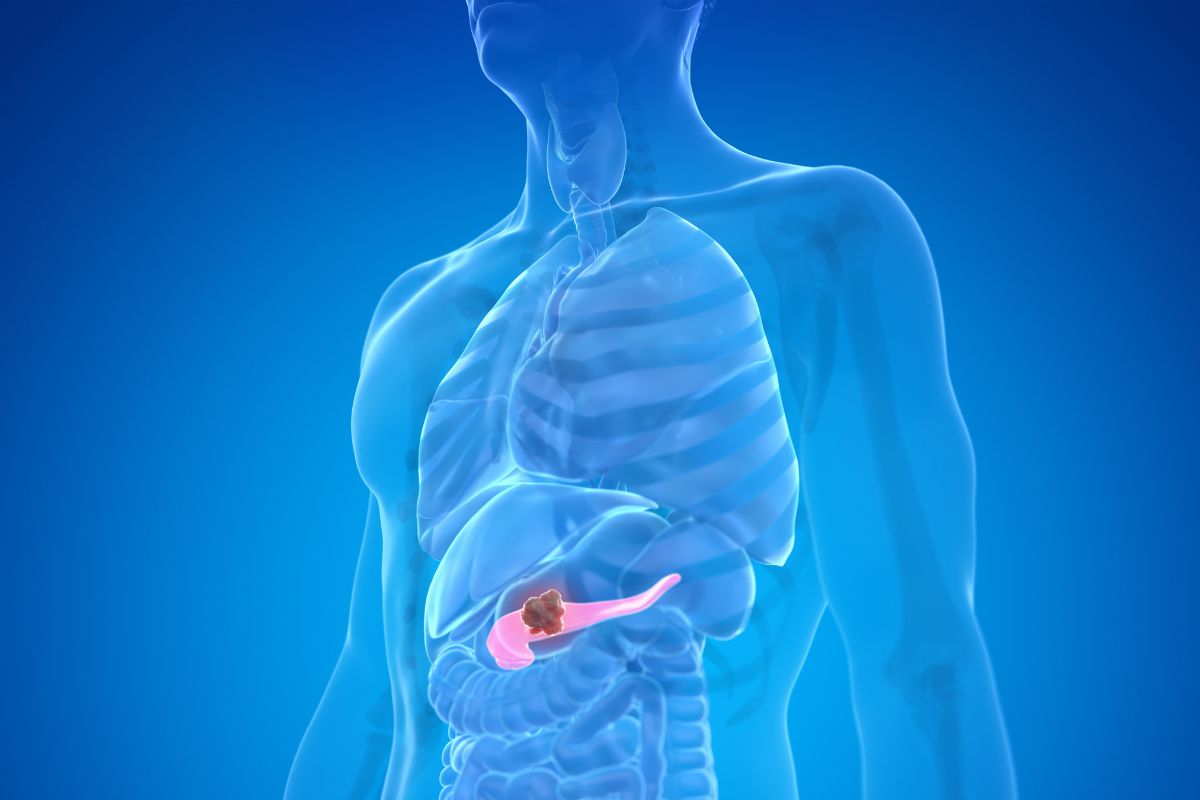 Cancro pancreas, sintomi